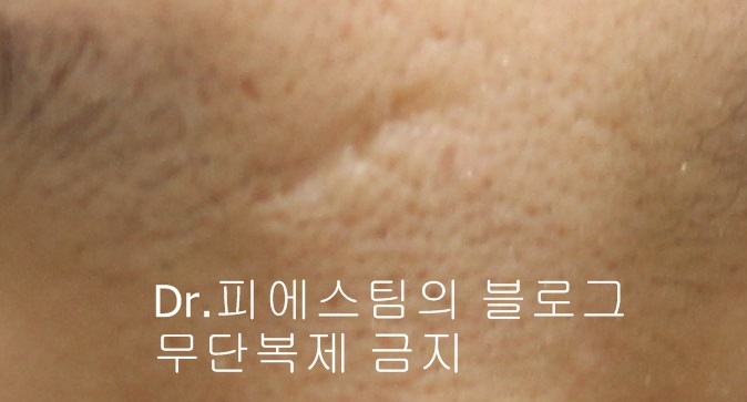 얼굴 찢어진 상처 봉합 성형외과 치료 사례 - 응급실 봉합 vs 성형외과 전문의 미세봉합 편입니다 관련 이미지 5