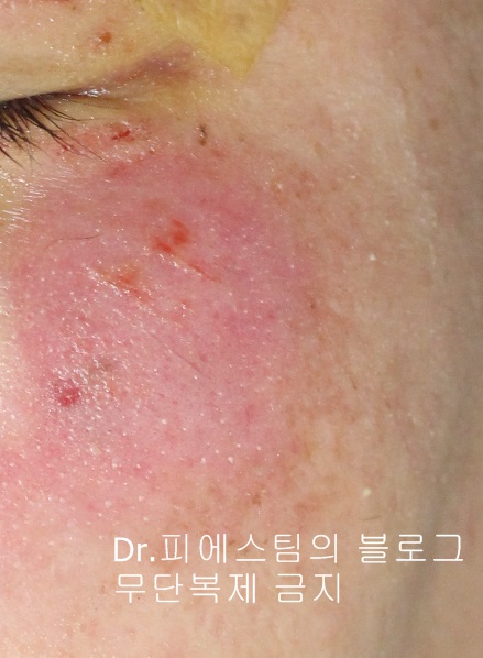 얼굴 상처 봉합 외 표재성 손상, 찰과상의 성형외과 색소침착 치료 사례 - 광대 편입니다 관련 이미지 2