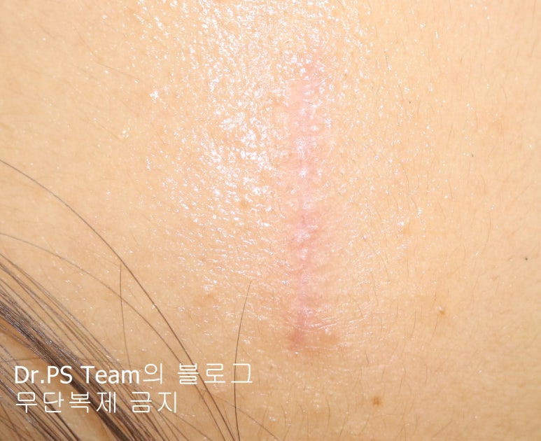 얼굴 찢어진 상처 봉합 & 얼굴 흉터 레이저 성형외과 치료 사례 - 이마 상처 (3) 편입니다. 관련 이미지 3