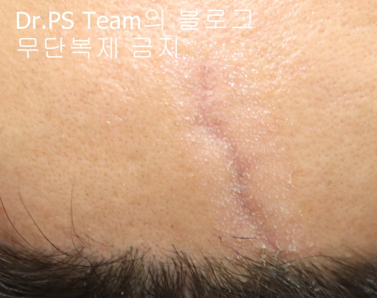 얼굴 찢어진 상처 봉합 & 얼굴 흉터 레이저 성형외과 치료 사례 - 이마 상처 (2) 편입니다. 관련 이미지 3