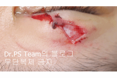 얼굴 찢어진 상처 미세 봉합 & 흉터 레이저 성형외과 치료 사례 - 상안검 편입니다. 관련 이미지 13