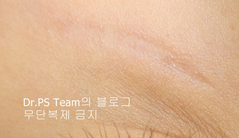 응급실에서 얼굴 상처 일반 봉합 후, 성형외과 흉터 레이저 치료 사례 - 하안검(아래눈꺼풀) 편 입니다 관련 이미지 8