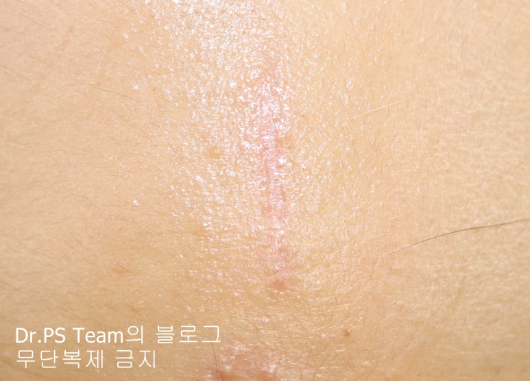 얼굴 찢어진 상처 봉합 & 얼굴 흉터 레이저 성형외과 치료 사례 - 이마 상처 (3) 편입니다. 관련 이미지 4