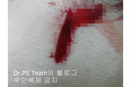 얼굴 찢어진 상처 봉합 & 얼굴 흉터 레이저 성형외과 치료 사례 - 이마 상처 (1) 편입니다. 관련 이미지 9
