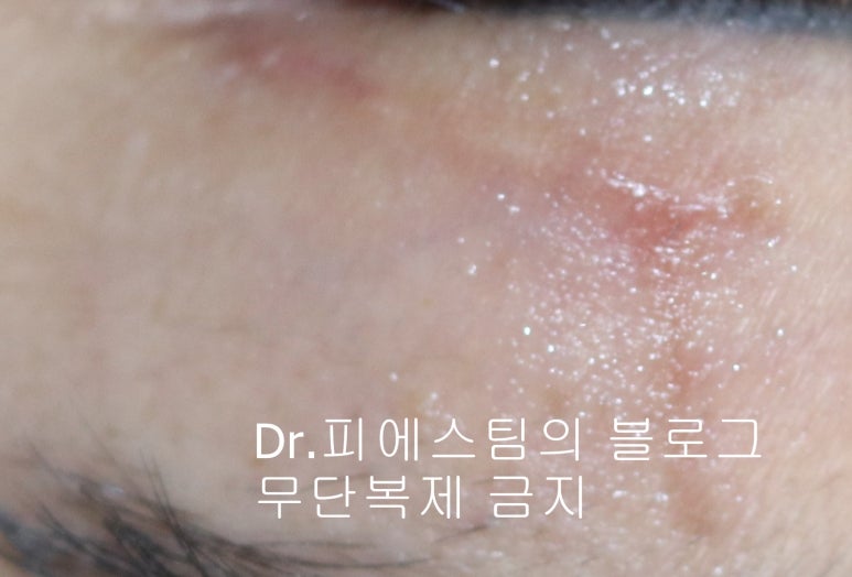 얼굴 찢어진 상처 봉합 성형외과 치료 사례 - 늦어진 상처 편입니다. 관련 이미지 4