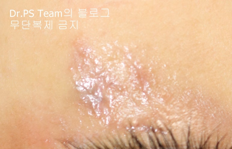 얼굴 찢어진 상처 봉합 & 얼굴 흉터 레이저 성형외과 치료 사례 - 늦어진 상처 봉합 (Delayed wound closure) II - 하안검 편입니다. 관련 이미지 3