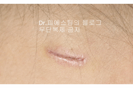 응급실에서 얼굴 상처 일반 봉합 후, 성형외과 흉터 레이저 치료 사례 - 뺨 & 이마 (2) 입니다 관련 이미지 15