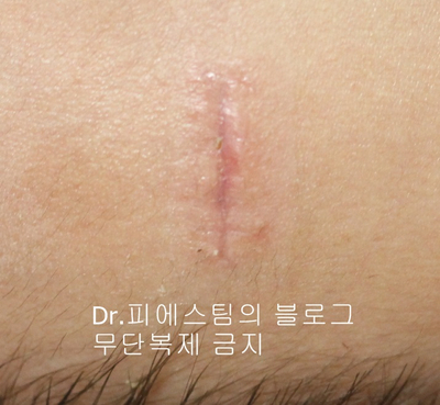 응급실에서 얼굴 상처 일반 봉합 후, 성형외과 흉터 레이저 치료 사례 - 뺨 & 이마 (2) 입니다 관련 이미지 1
