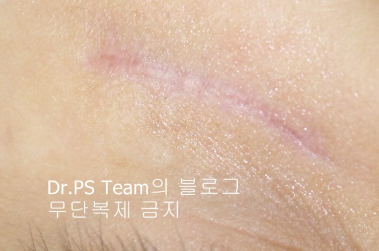응급실에서 얼굴 상처 일반 봉합 후, 성형외과 흉터 레이저 치료 사례 - 하안검(아래눈꺼풀) 편 입니다 관련 이미지 3