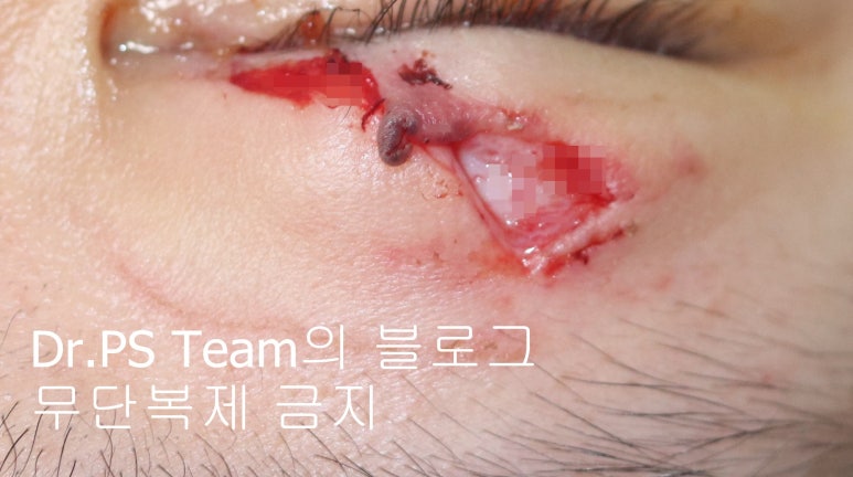 얼굴 찢어진 상처 미세 봉합 & 흉터 레이저 성형외과 치료 사례 - 상안검 편입니다. 관련 이미지 6
