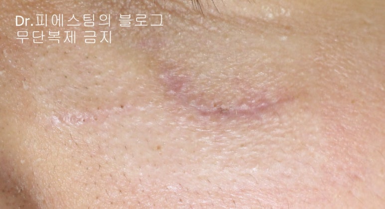 얼굴 찢어진 상처 봉합 성형외과 치료 사례 - 들린 상처: 피판에 관하여 2편입니다 입니다 관련 이미지 10