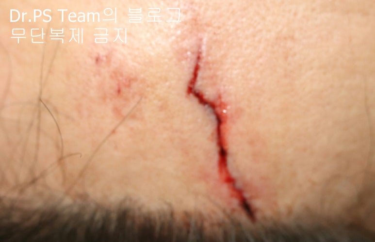 얼굴 찢어진 상처 봉합 & 얼굴 흉터 레이저 성형외과 치료 사례 - 이마 상처 (2) 편입니다. 관련 이미지 1