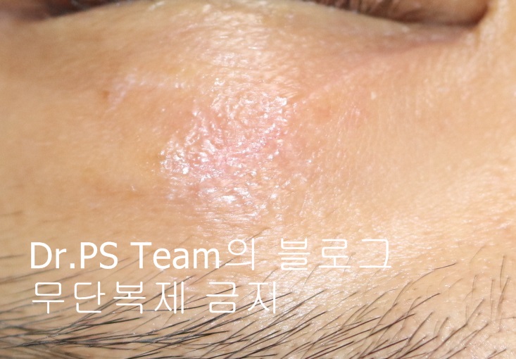 얼굴 찢어진 상처 미세 봉합 & 흉터 레이저 성형외과 치료 사례 - 상안검 편입니다. 관련 이미지 4