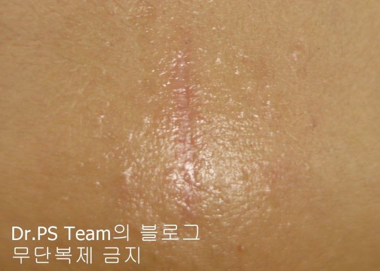 얼굴 찢어진 상처 봉합 & 얼굴 흉터 레이저 성형외과 치료 사례 - 이마 상처 (3) 편입니다. 관련 이미지 5
