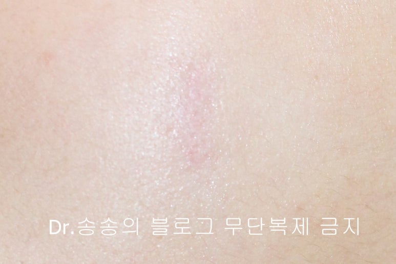 얼굴 상처 봉합 성형외과 치료 사례 - 뺨 1편 관련 이미지 10