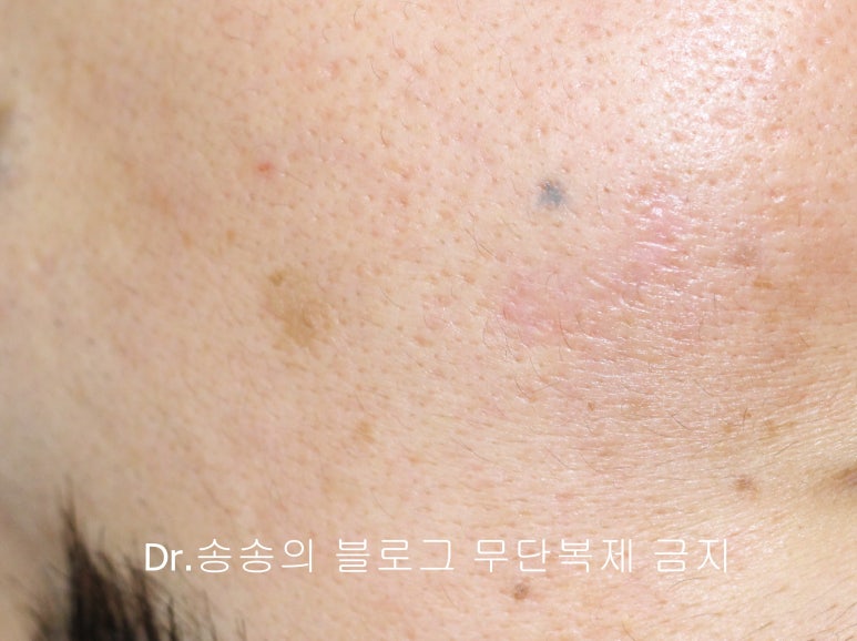 얼굴 찢어진 상처 봉합 성형외과 치료 사례 - 들린 상처 (일명 트랩도어) 편입니다 관련 이미지 11