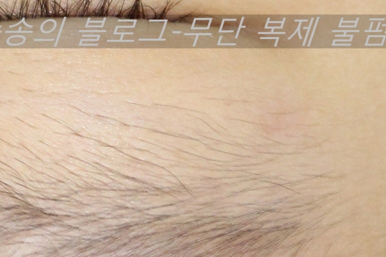 얼굴 상처 봉합 성형외과 치료 사례 - 눈꺼풀 1편 관련 이미지 15