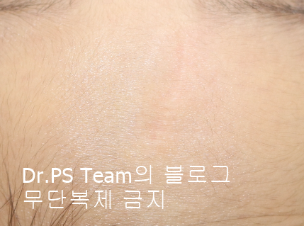 얼굴 찢어진 상처 봉합 & 얼굴 흉터 레이저 성형외과 치료 사례 - 이마 상처 (1) 편입니다. 관련 이미지 8