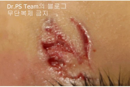 얼굴 찢어진 상처 봉합 & 얼굴 흉터 레이저 성형외과 치료 사례 - 늦어진 상처 봉합 (Delayed wound closure) II - 하안검 편입니다. 관련 이미지 8