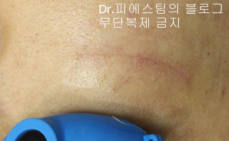 얼굴 찢어진 상처 봉합 성형외과 치료 사례 - 들린 상처: 피판에 관하여 2편입니다 입니다 관련 이미지 5