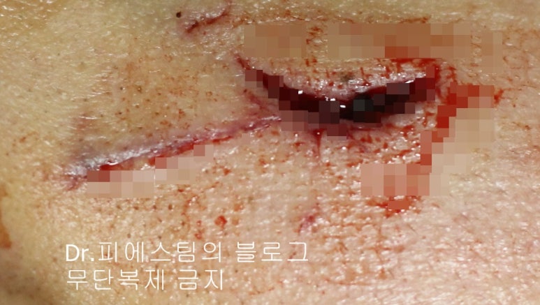 얼굴 찢어진 상처 봉합 성형외과 치료 사례 - 들린 상처: 피판에 관하여 2편입니다 입니다 관련 이미지 8