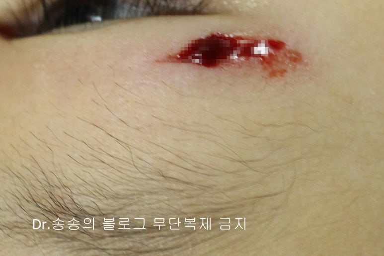 얼굴 상처 봉합 성형외과 치료 사례 - 눈꺼풀 2편 관련 이미지 1
