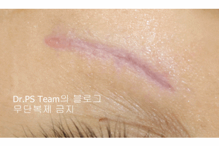 응급실에서 얼굴 상처 일반 봉합 후, 성형외과 흉터 레이저 치료 사례 - 하안검(아래눈꺼풀) 편 입니다 관련 이미지 11