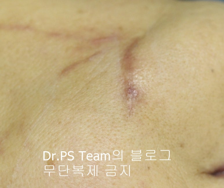 얼굴 찢어진 상처 봉합 & 얼굴 흉터 레이저 성형외과 치료 사례 - 턱 : 긴 상처 편입니다. 관련 이미지 3