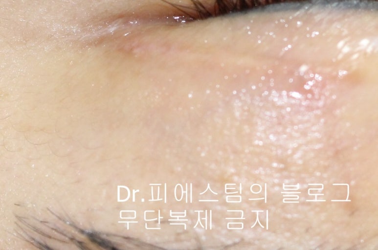 얼굴 찢어진 상처 봉합 성형외과 치료 사례 - 늦어진 상처 편입니다. 관련 이미지 2