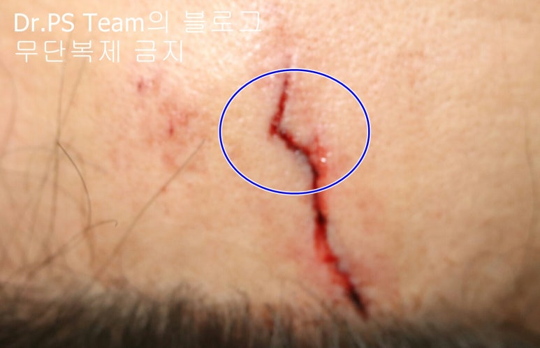 얼굴 찢어진 상처 봉합 & 얼굴 흉터 레이저 성형외과 치료 사례 - 이마 상처 (2) 편입니다. 관련 이미지 6