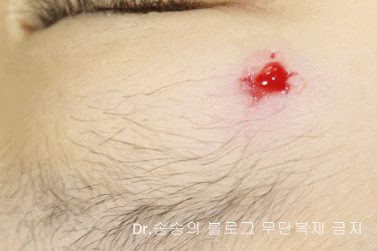 얼굴 상처 봉합 성형외과 치료 사례 - 눈꺼풀 1편 관련 이미지 17
