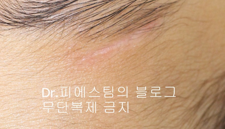 얼굴 찢어진 상처 봉합 성형외과 치료 사례 - 응급실 봉합 vs 성형외과 전문의 미세봉합 편입니다 관련 이미지 4
