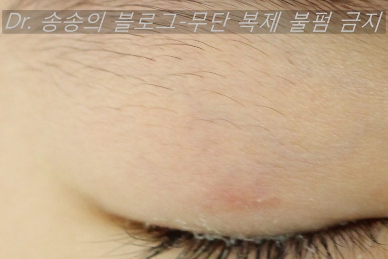 얼굴 상처 봉합 성형외과 치료 사례 - 눈꺼풀 1편 관련 이미지 5