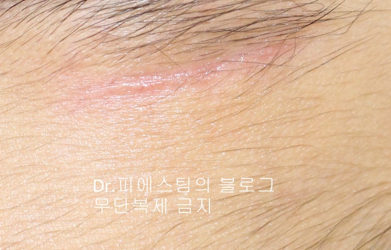 얼굴 찢어진 상처 봉합 성형외과 치료 사례 - 응급실 봉합 vs 성형외과 전문의 미세봉합 편입니다 관련 이미지 3