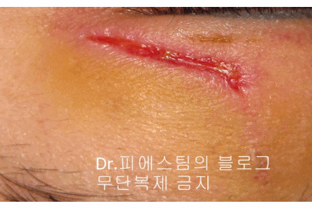 얼굴 찢어진 상처 봉합 성형외과 치료 사례 - 늦어진 상처 편입니다. 관련 이미지 7