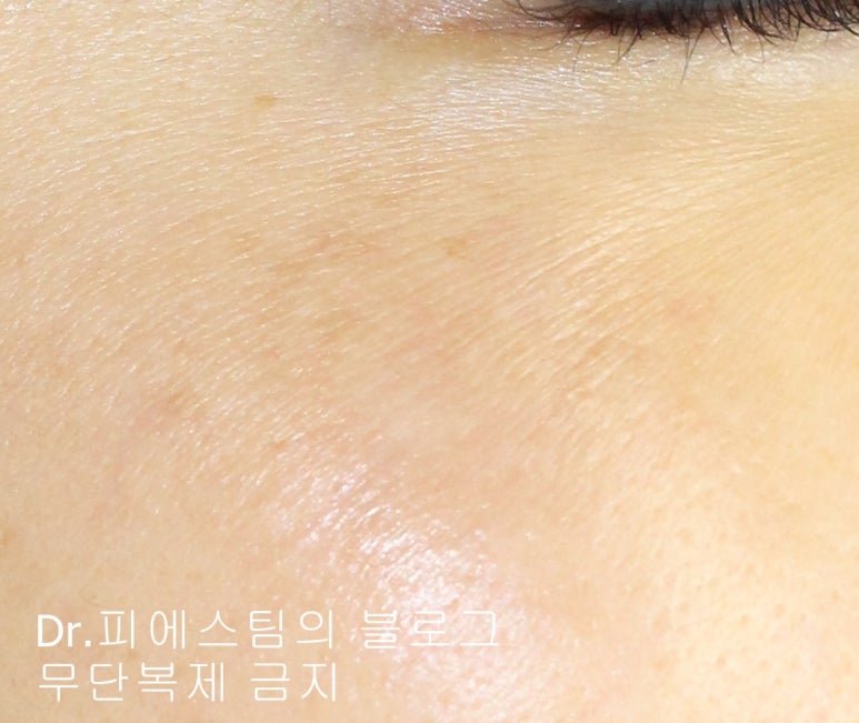 얼굴 상처 봉합 외 표재성 손상, 찰과상의 성형외과 색소침착 치료 사례 - 광대 편입니다 관련 이미지 11