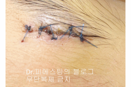 얼굴 찢어진 상처 봉합 성형외과 치료 사례 - 응급실 봉합 vs 성형외과 전문의 미세봉합 편입니다 관련 이미지 9