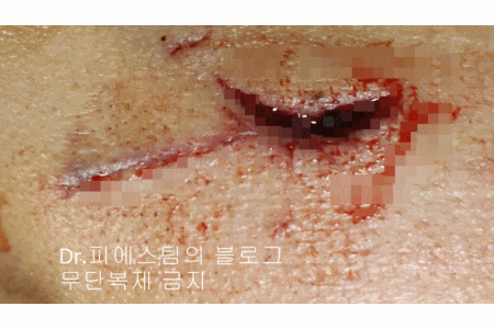 얼굴 찢어진 상처 봉합 성형외과 치료 사례 - 들린 상처: 피판에 관하여 2편입니다 입니다 관련 이미지 14