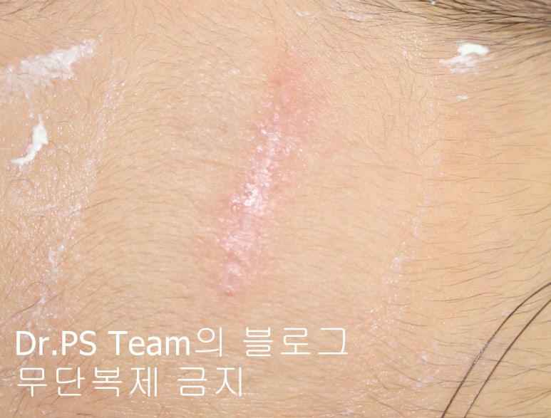 얼굴 찢어진 상처 봉합 & 얼굴 흉터 레이저 성형외과 치료 사례 - 이마 상처 (1) 편입니다. 관련 이미지 6
