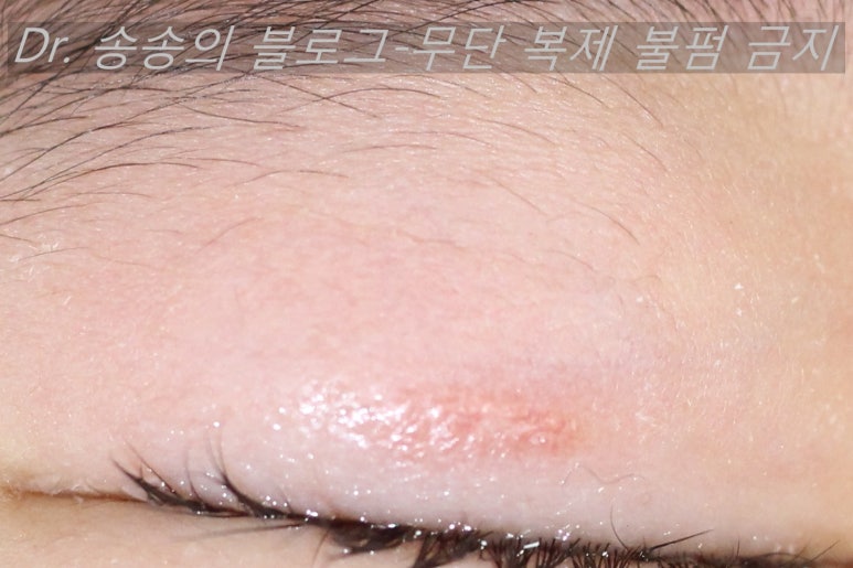 얼굴 상처 봉합 성형외과 치료 사례 - 눈꺼풀 1편 관련 이미지 4