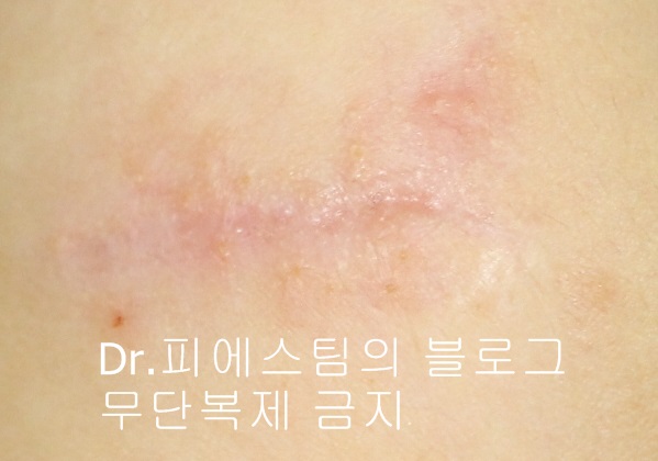 응급실에서 얼굴 상처 일반 봉합 후, 성형외과 레이저 치료 사례 - 뺨 & 이마 (1) 입니다 관련 이미지 4