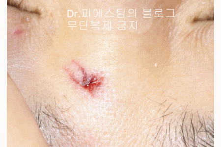 얼굴 찢어진 상처 봉합 성형외과 치료 사례 - 코와 피판에 관하여-1편입니다 관련 이미지 11