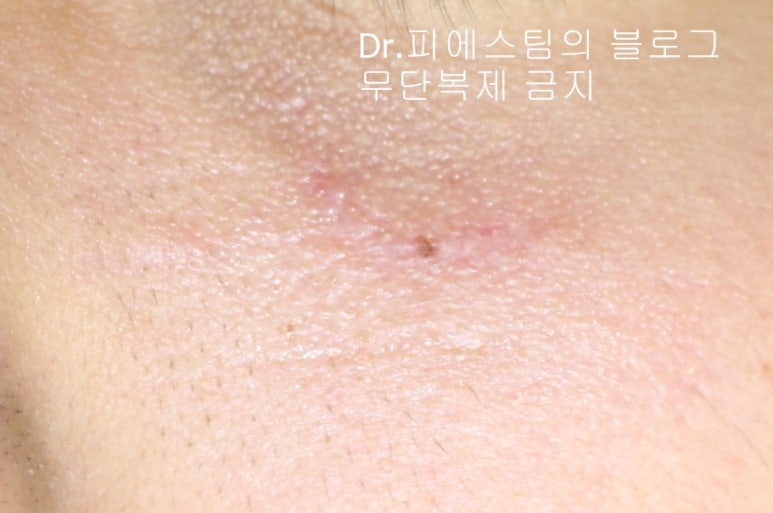 얼굴 찢어진 상처 봉합 성형외과 치료 사례 - 들린 상처: 피판에 관하여 2편입니다 입니다 관련 이미지 11