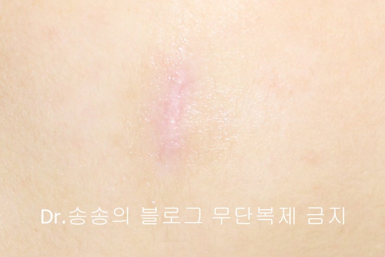 얼굴 상처 봉합 성형외과 치료 사례 - 뺨 1편 관련 이미지 7