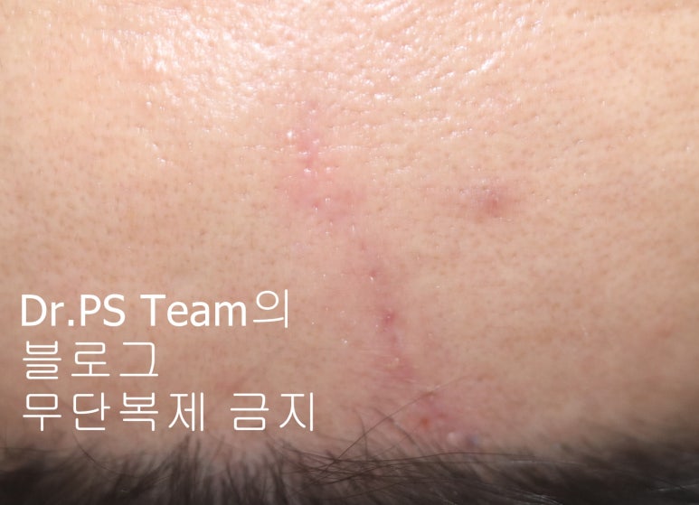 얼굴 찢어진 상처 봉합 & 얼굴 흉터 레이저 성형외과 치료 사례 - 이마 상처 (2) 편입니다. 관련 이미지 5