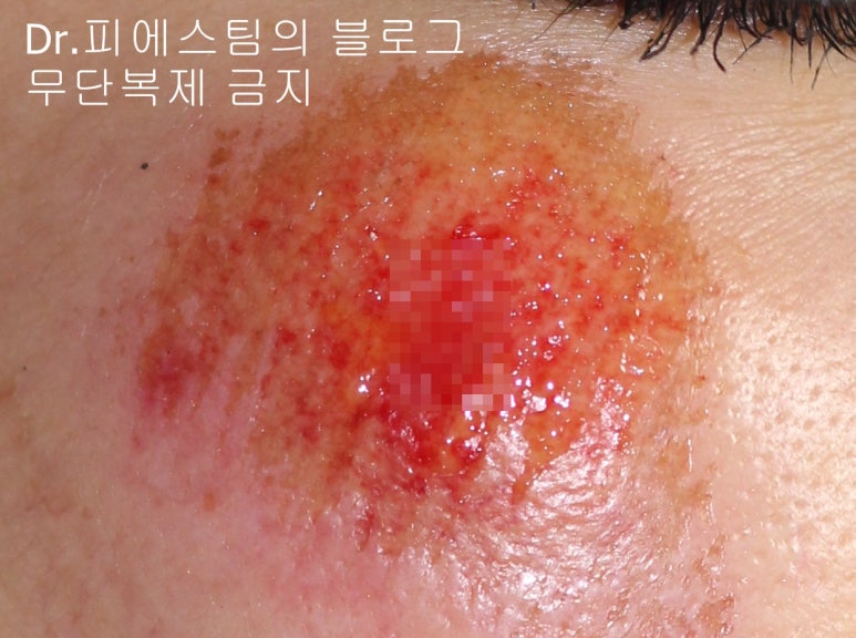 얼굴 상처 봉합 외 표재성 손상, 찰과상의 성형외과 색소침착 치료 사례 - 광대 편입니다 관련 이미지 8