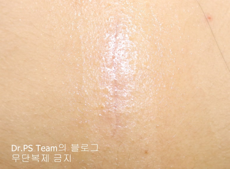 얼굴 찢어진 상처 봉합 & 얼굴 흉터 레이저 성형외과 치료 사례 - 이마 상처 (3) 편입니다. 관련 이미지 2