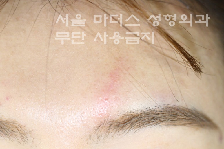 얼굴 상처 봉합 성형외과 - 이마 상처 : 미세 봉합 & 흉터 레이저 관련 이미지 7