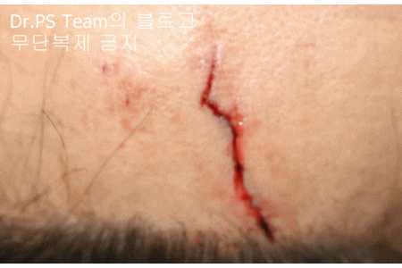 얼굴 찢어진 상처 봉합 & 얼굴 흉터 레이저 성형외과 치료 사례 - 이마 상처 (2) 편입니다. 관련 이미지 9