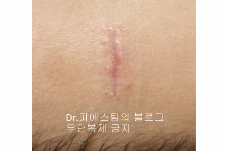 응급실에서 얼굴 상처 일반 봉합 후, 성형외과 흉터 레이저 치료 사례 - 뺨 & 이마 (2) 입니다 관련 이미지 12